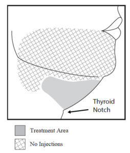 Avoid the Marginal Mandibular Nerve Area